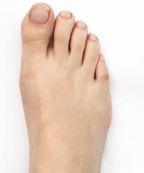 I cured my thumb valgus with Hondro Sol Valgus spray