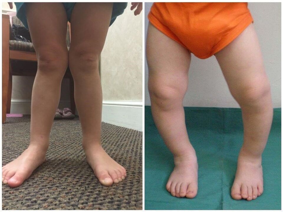 Deformation of valgus in children causes
