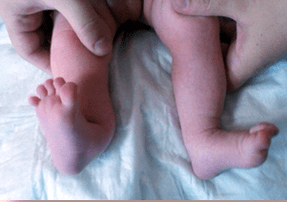 Deformation of valgus in symptoms of children