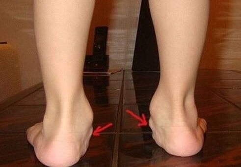 Valgus deformation of the feet in children